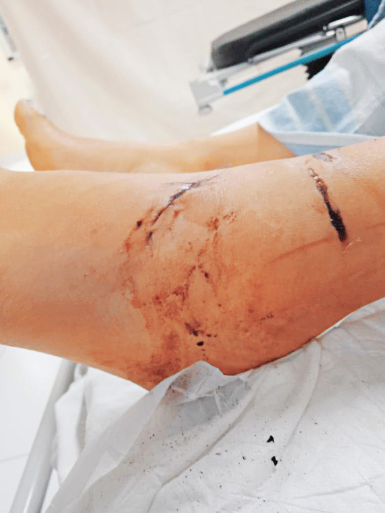 Parte de las lesiones que sufrió, luego de ser atropellada.